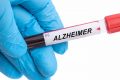 Análisis de sangre para predecir el alzhéimer: comienza una nueva era en la prevención